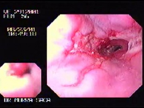 Refluksowe Zapalenie Przełyku & Zwężenie Przełyku - 56-letnia Pacjentka