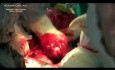 Operacja olbrzymiego nerwiaka osłonkowego śródpiersia