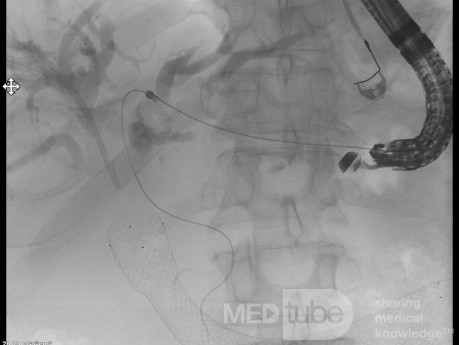 Endoskopowa hepaticogastrostomia pod kontrolą EUS [4/10]