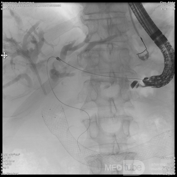 Endoskopowa hepaticogastrostomia pod kontrolą EUS [4/10]