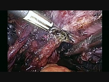 Radykalna histerektomia laparoskopowa i limphadenectomia biodrowo, zasłonowa oraz okołoaortalna w raku neuroendokrynnym szyjki macicy