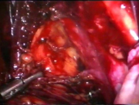 Wycięcie węzłów chłonnych z wykorzystaniem technik laparoskopowych