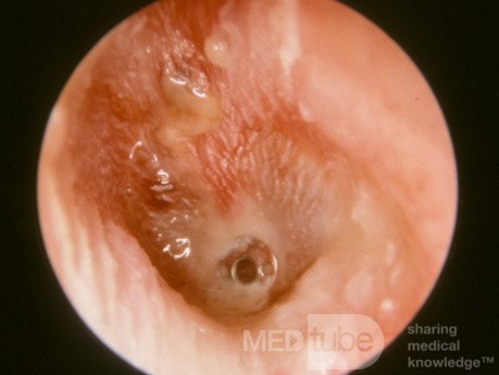 Ostre zapalenie ucha środkowego z umieszczoną rurką wentylacyjną (AOMT)