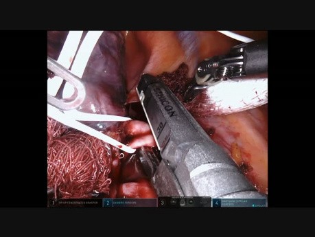 Rak płata górnego płuca prawego - lobektomia z użyciem robota