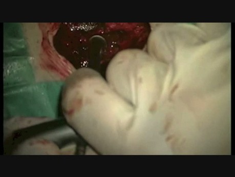 Spondylodeza lędźwiowa poprzez artrodezę międzykręgową implantem