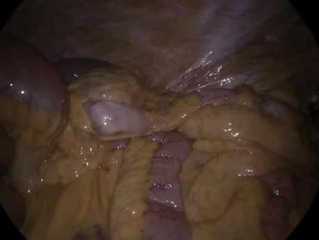 Przepuklina wewnętrzna po laparoskopowej operacji kolorektalnej
