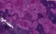Histiocytoza X - histopatologia - węzeł chłonny