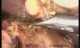 Cholecystektomia laparoskopowa metodą dwóch małych cięć