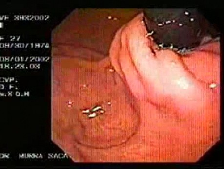 Badanie endoskopowe po wykonaniu fundoplikacji (2 z 5)