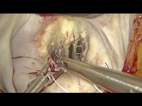 Endoskopowa operacja zastawki mitralnej z ostrym zerwaniem struny ścięgnistej