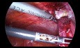 Postępowanie laparoskopowe ze zrostami jelita cienkiego