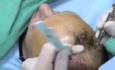 Transplantacja włosów - ustawienie urządzenia