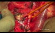 Chirurgia cytoredukcyjna raka jajnika. Histerektomia Hudsona.