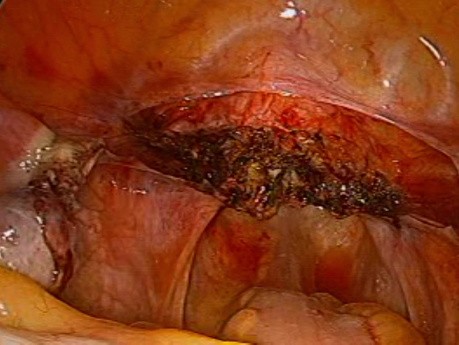 SELS - laparoskopowa nadszyjkowa amputacja trzonu macicy