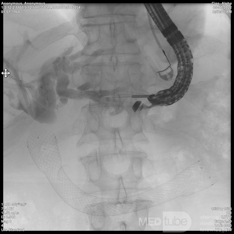 Endoskopowa hepaticogastrostomia pod kontrolą EUS [2/10]