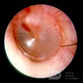 Wczesne ostre zapalenie ucha środkowego (stadium zaczerwienienia)