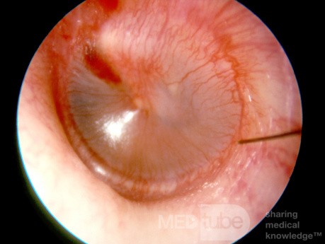 Wczesne ostre zapalenie ucha środkowego (stadium zaczerwienienia)