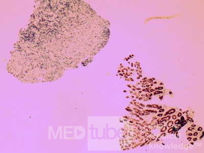 Chłoniak nieziarniczy z komórek B typu MALT  (4 z 7)