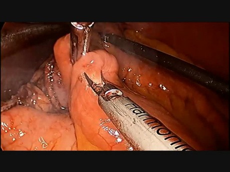 Wyłączenie żołądkowe metodą "Mini-Gastric Bypass" - efektywna operacja bariatryczna