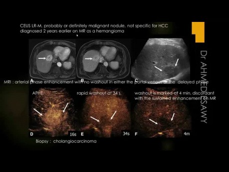 Diagnostyka obrazowa chorób wątroby - WZW, PSC, AIH, PBC