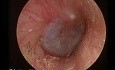 Pulsująca błona bębenkowa w wydzielniczym zapaleniu ucha środkowego