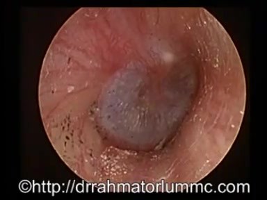 Pulsująca błona bębenkowa w wydzielniczym zapaleniu ucha środkowego