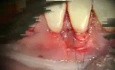 Mikrochirurgia periodontologiczna: przeszczep materiału allogennego