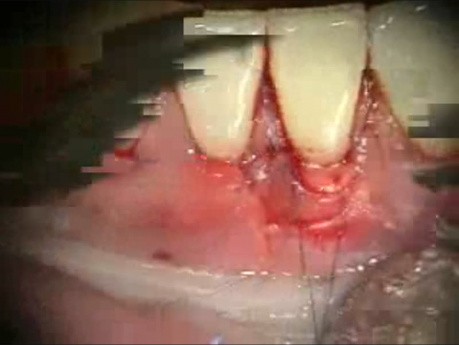 Mikrochirurgia periodontologiczna: przeszczep materiału allogennego