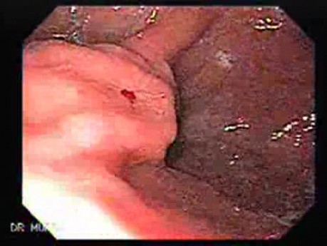 Żylaki żołądka - endoskopowa ablacja klejem cyjanoakrylowym (17 z 18)