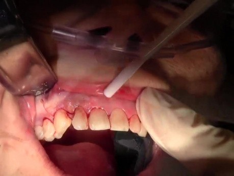 Atraumatyczna ektrakcja zęba 1-7 z przeszczepem kostnym kieszeni
