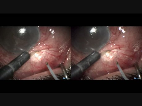 Przypadek chirurgii VR - mikroprzetoka filtracyjna