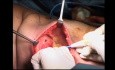 Operacja raka piersi - mastektomia "skin sparing" z rekonstrukcją przy użyciu płata mięśnia najszerszego grzbietu