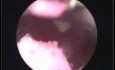 Histeroskopia w macicy (sztucznej)
