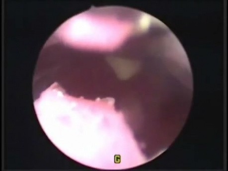 Histeroskopia w macicy (sztucznej)