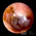 Duży ziarniak cholesterolowy w uchu środkowym