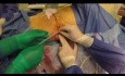 Podskórny bypass moczowodu w przypadku zwężenia moczowodu