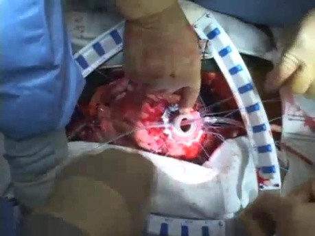 Implantacja Heartmate II LVAD