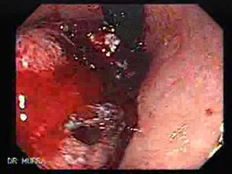 Rak gruczołowy trzonu i dna żołądka (3 z 4)