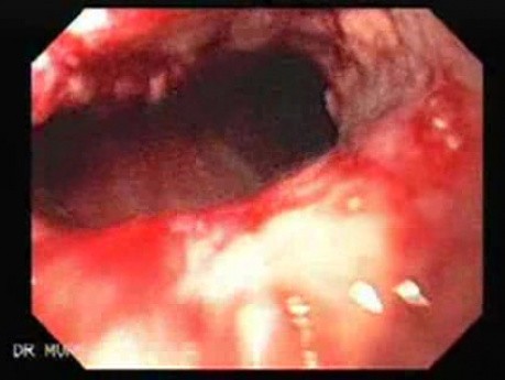 Synchroniczny rak żołądka i przełyku - obraz endoskopowy środkowej części przełyku