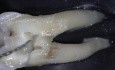 Dostęp endodontyczny oparty na występującej próchnicy (CLA) oraz techniki jednego uderzenia (TCA)