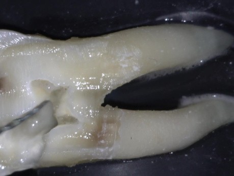 Dostęp endodontyczny oparty na występującej próchnicy (CLA) oraz techniki jednego uderzenia (TCA)
