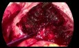 SELS - endometrioza głęboko naciekająca