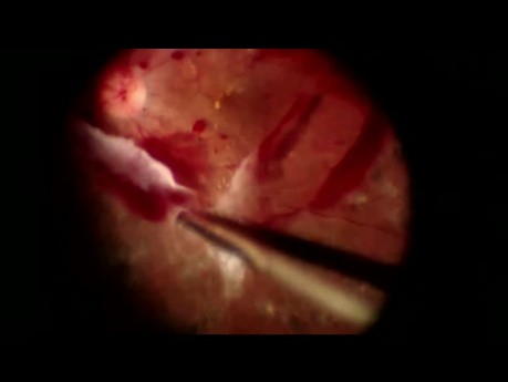 Dysekcja ciała szklistego w trakcyjnym odwarstwieniu siatkówki w przebiegu proliferacyjnej retinopatii cukrzycowej