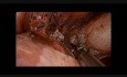 Torakoskopowa resekcja torbieli bronchogennej śródpiersia u 17-letniej pacjentki