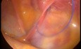 Przepuklina pachwinowa u dziecka operowana laparoskopowo sposobem PIRS