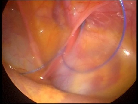 Przepuklina pachwinowa u dziecka operowana laparoskopowo sposobem PIRS