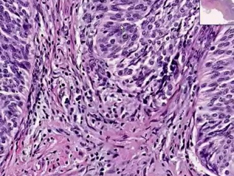 Rak urotelialny stopnia I - histopatologia - pęcherz moczowy