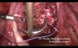 Miomektomia z kontrolą tętnic biodrowych wewnętrznych