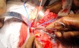 Wilms' Tumor with IVC Thrombus