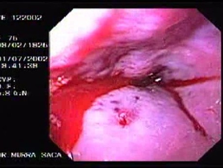 Krwotok - podwiązywanie żylaków przełyku (gumowa opaska) - krwawienie i zakrzep